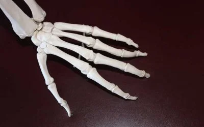 Arthritis1