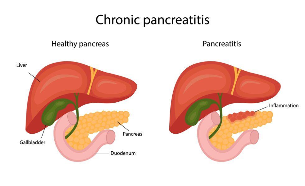 chronic pancreatitis