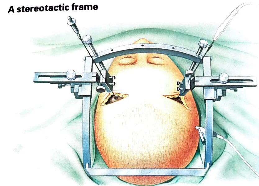 leucotomy frame