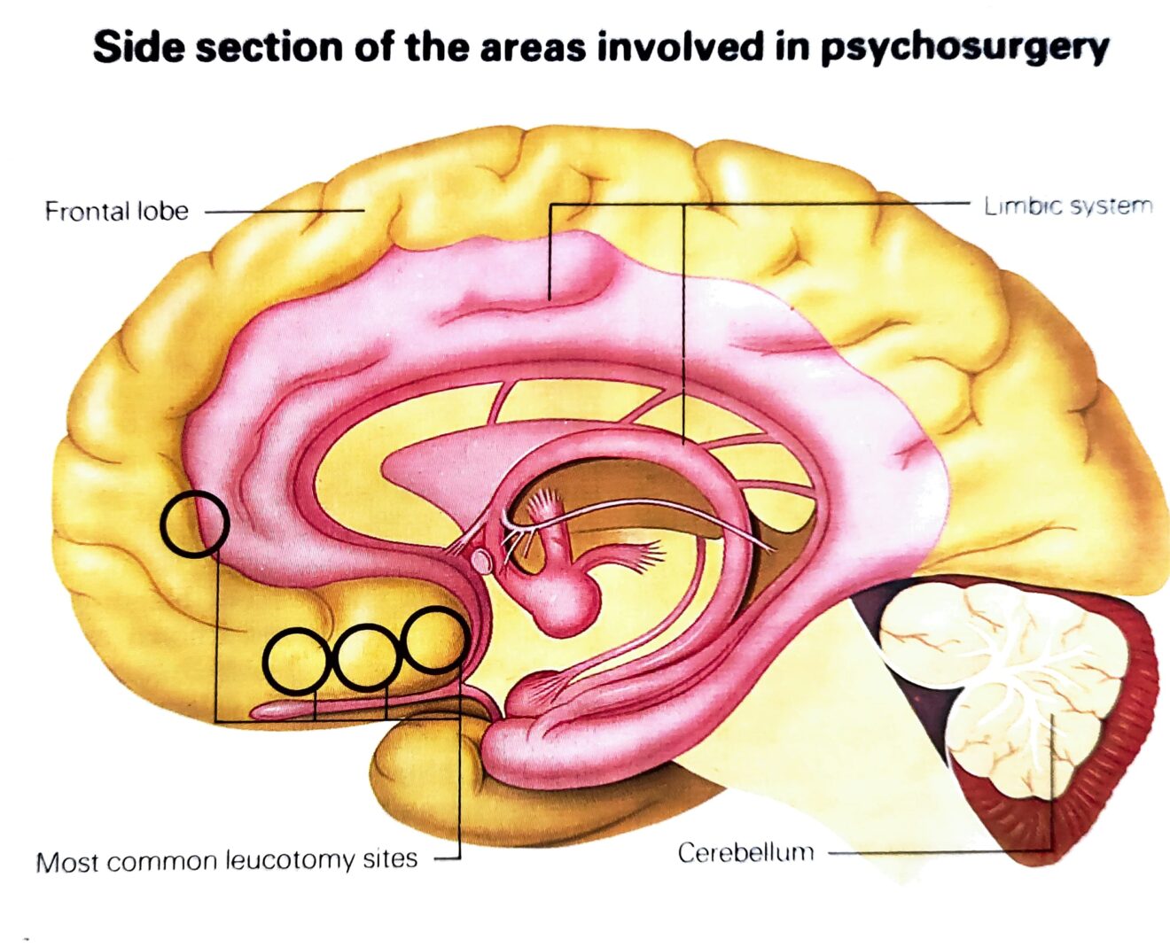 Leucotomy: Techniques, Treatment And Outlook » FreakToFit