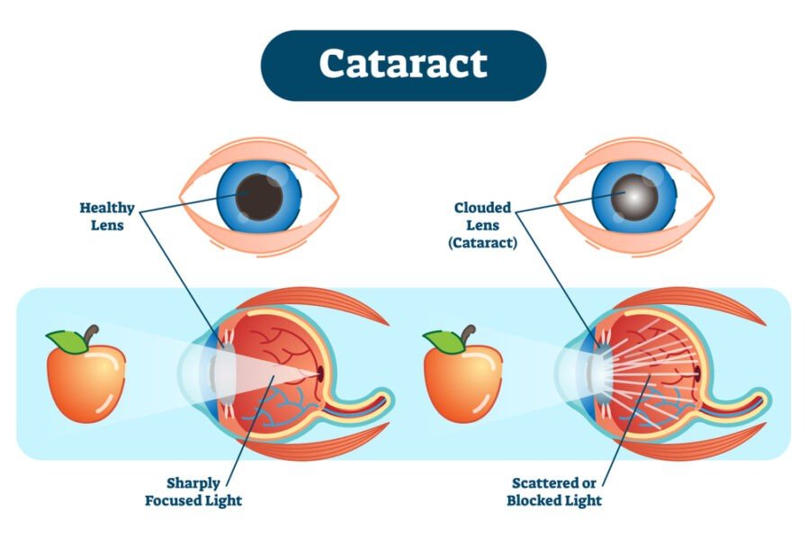 cataract care of eyes