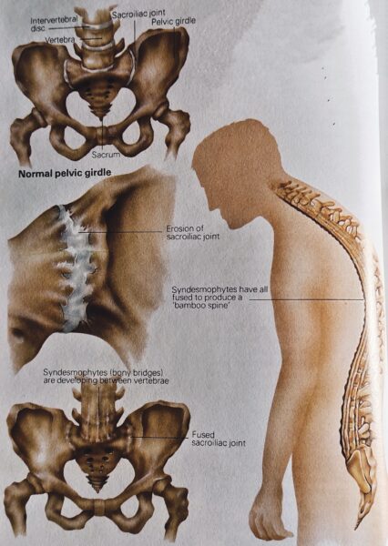 cause of ankylosing Spondylitis