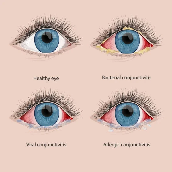conjunctivitis care of eyes