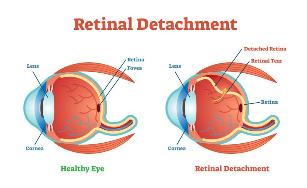 detachment of retina