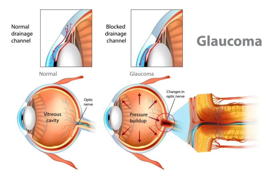 glaucoma