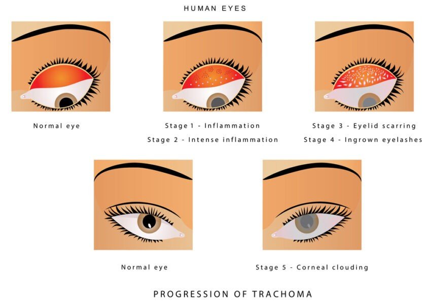 trachoma care of eyes