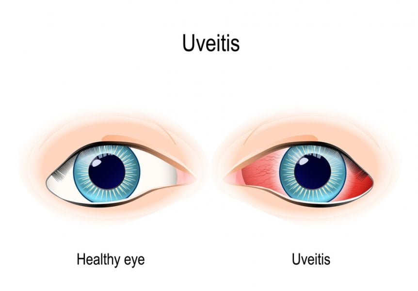 What Is The Uvea Of The Eye Freaktofit