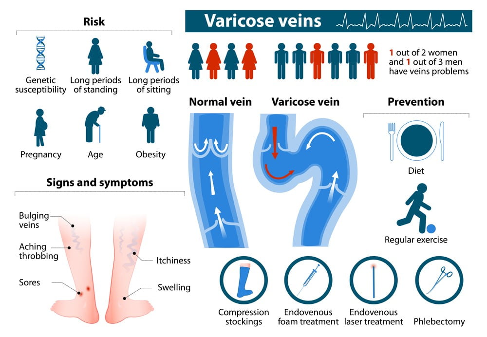 Guidelines for Varicose Veins According To ICD 10 » FreakToFit