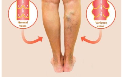 varicose veins ocd 10