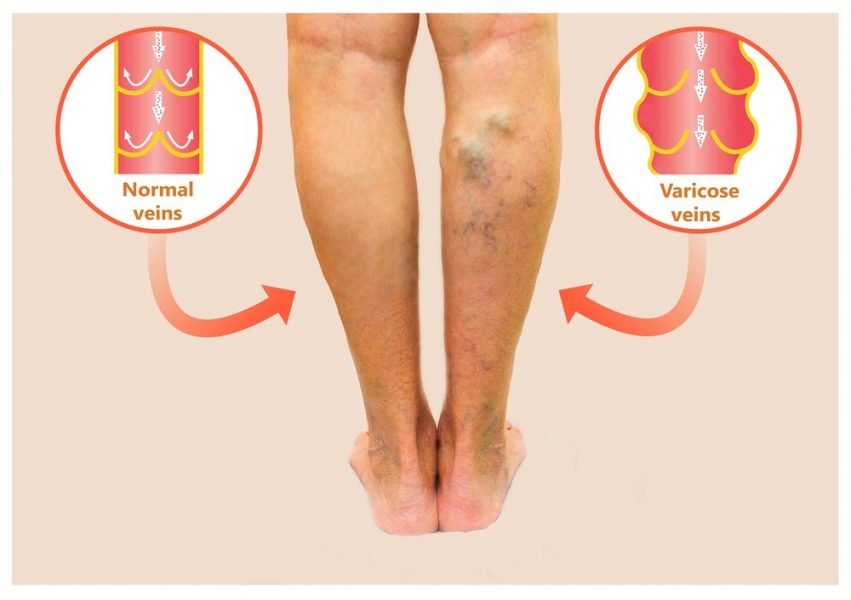 varicose veins ocd 10