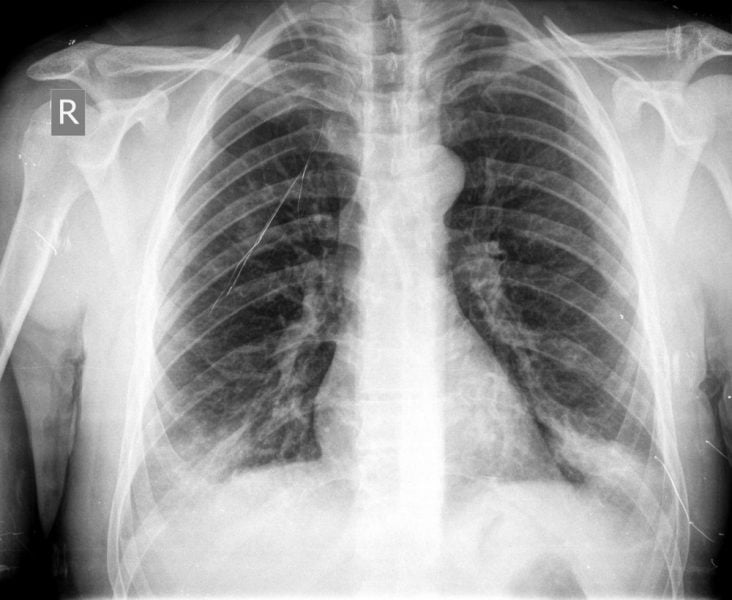 chest x-ray Benefits of Cashew In Tuberculosis