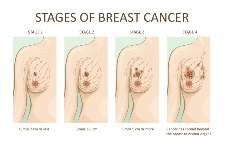 stages of breast cancer