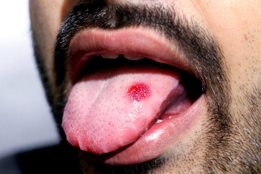 Tongue Infection