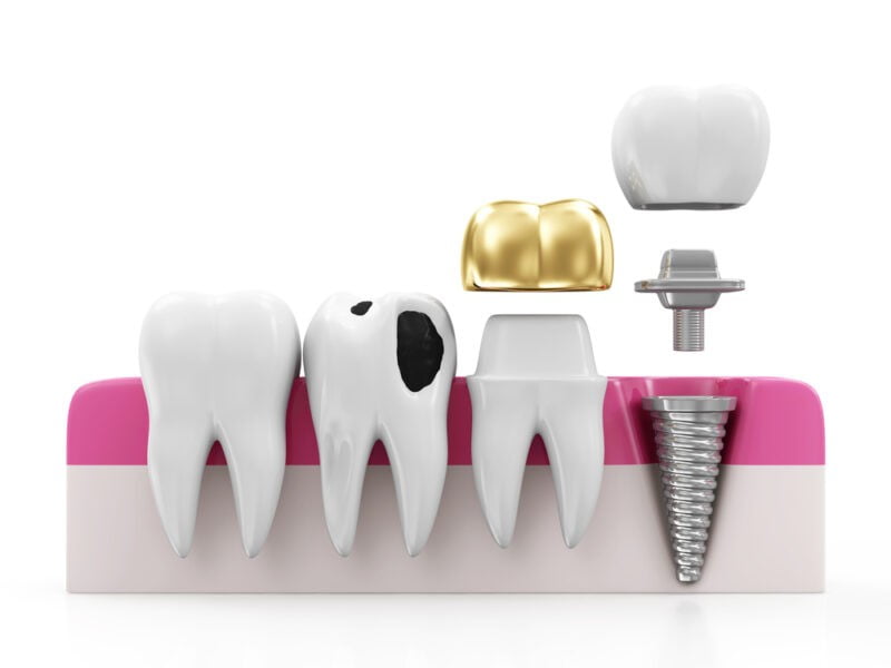 Permanent Crown Fell Out FreakToFit