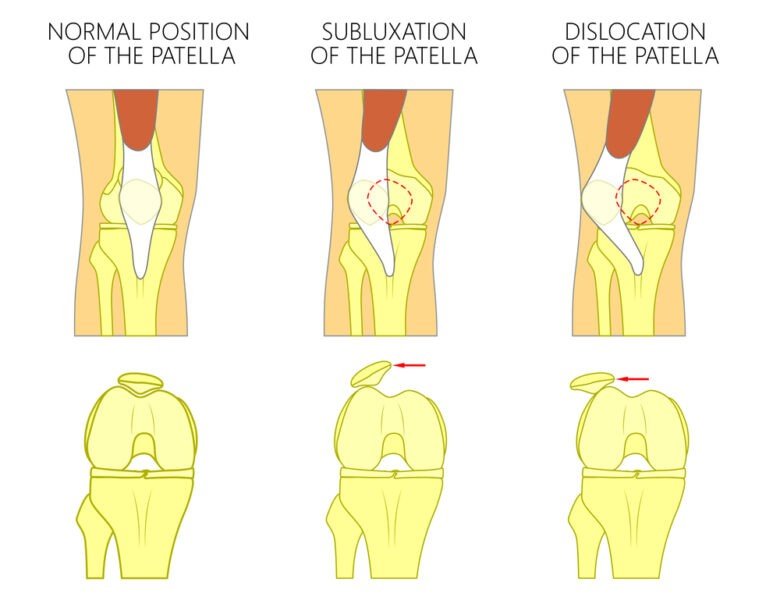 Patellar Subluxation