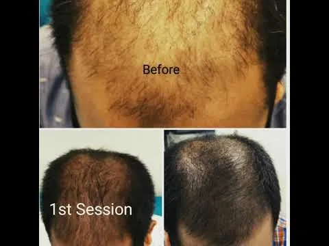 Amazing GFC Therapy For Hair Loss : Is It Really Safe Than PRP? 2 GFC Therapy