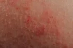 4 Best Home Treatments for Skin Rash Looks Like Hickey on Breast