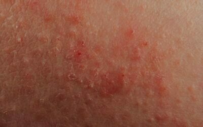 4 Best Home Treatments for Skin Rash Looks Like Hickey on Breast