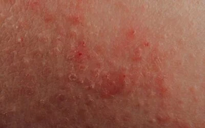 Skin Rash Looks Like Hickey On Breast