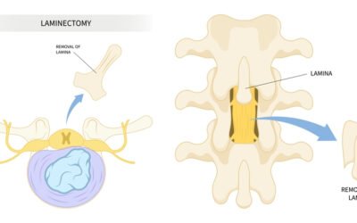 Exercises to Avoid After a Lumbar Laminectomy