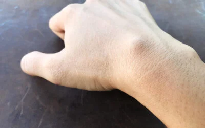 ganglion cyst wrist exercises