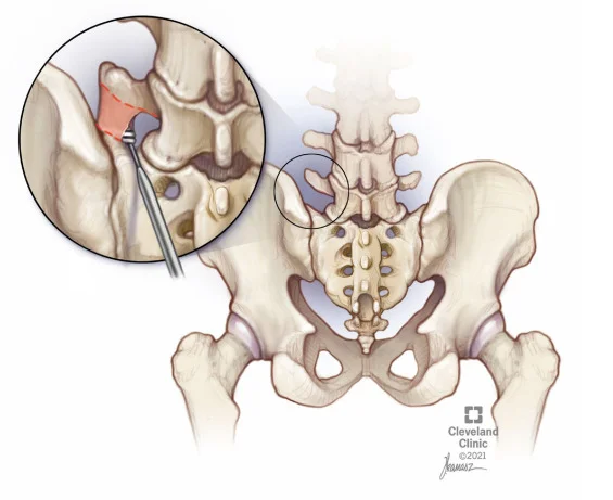 Bertolotti Syndrome