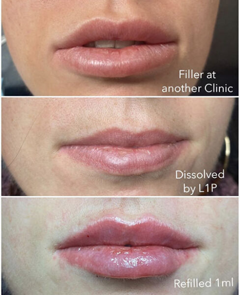 Lip Filler Migration Bottom Lip