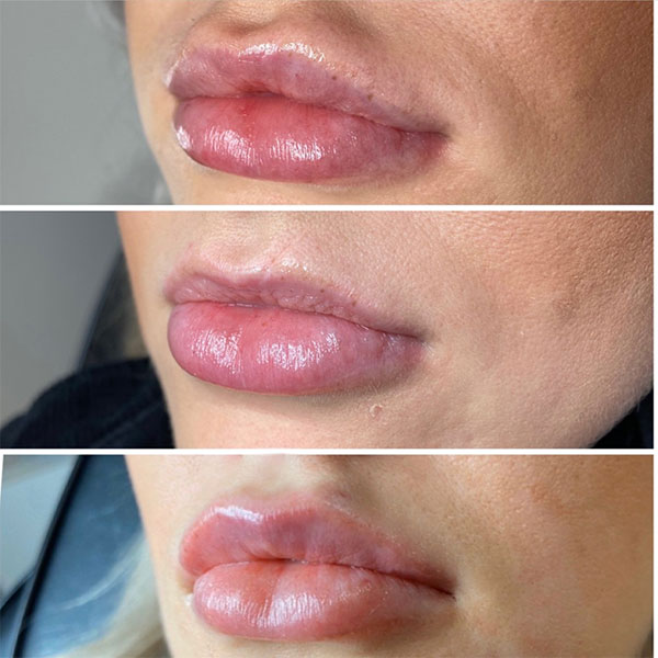 Lip Filler Migration Side Profile