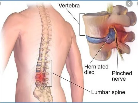 Lumbar Spondylosis