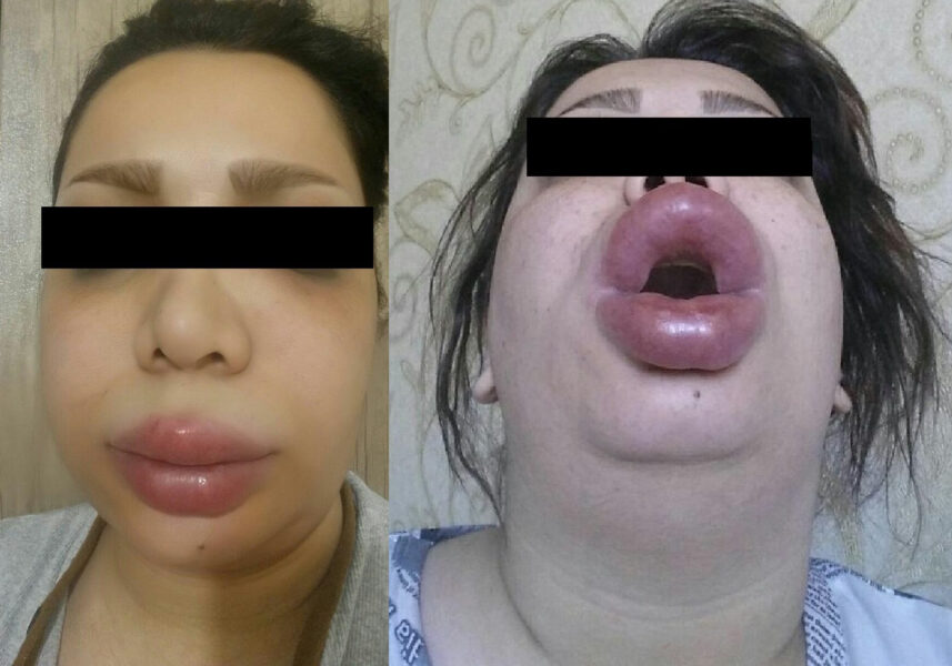 Lip Filler Migration Severe Cases