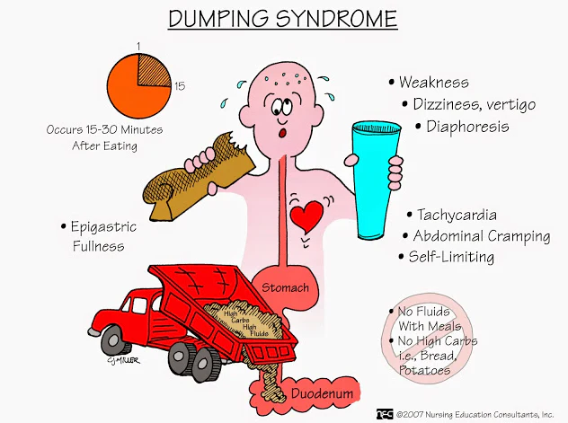 Dumping Syndrome