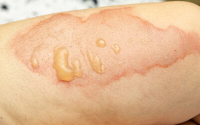 Turf Burn: Causes, Symptoms, Treatment, Prevention and How to Treat at Home