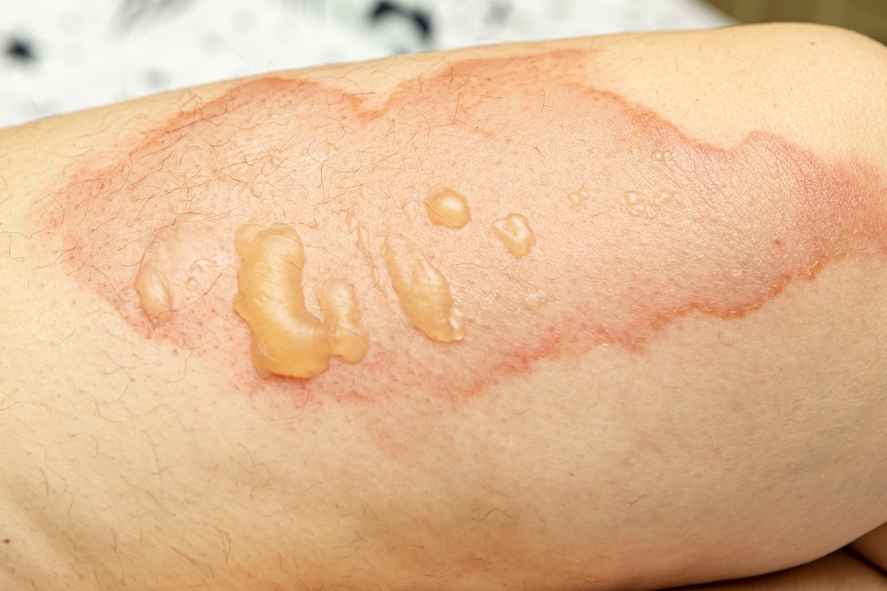 Turf Burn: Causes, Symptoms, Treatment, Prevention and How to Treat at Home