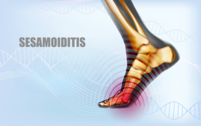 Sesamoiditis