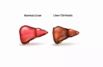 Liver Cirrhosis Treatment and Prevention: Protecting Your Liver for Life