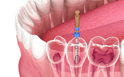 Modern Dentistry Makes Re-Root Canal Easier Than You Think. Modern Dentistry