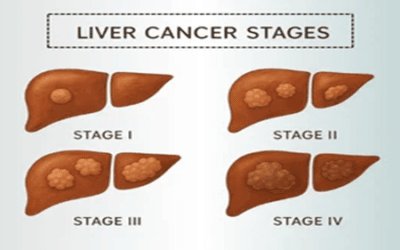 Stage-Wise Liver Cancer Management: Treatment Plans Explained Clearly Stage-Wise Liver Cancer Management